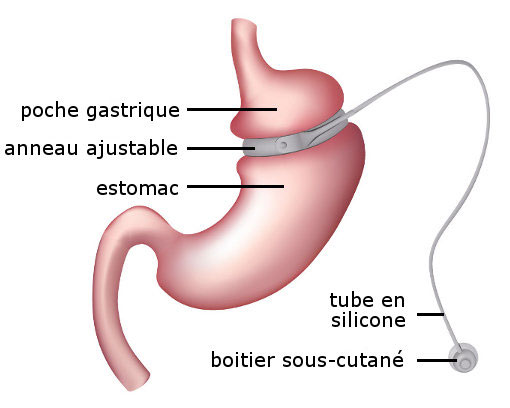 anneau gastrique