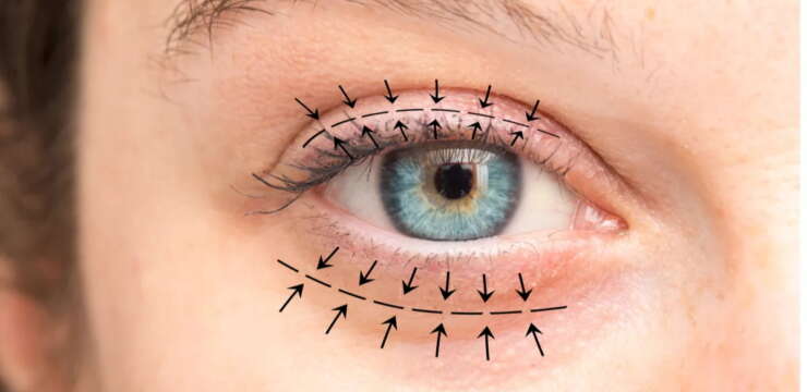 blepharoplastie