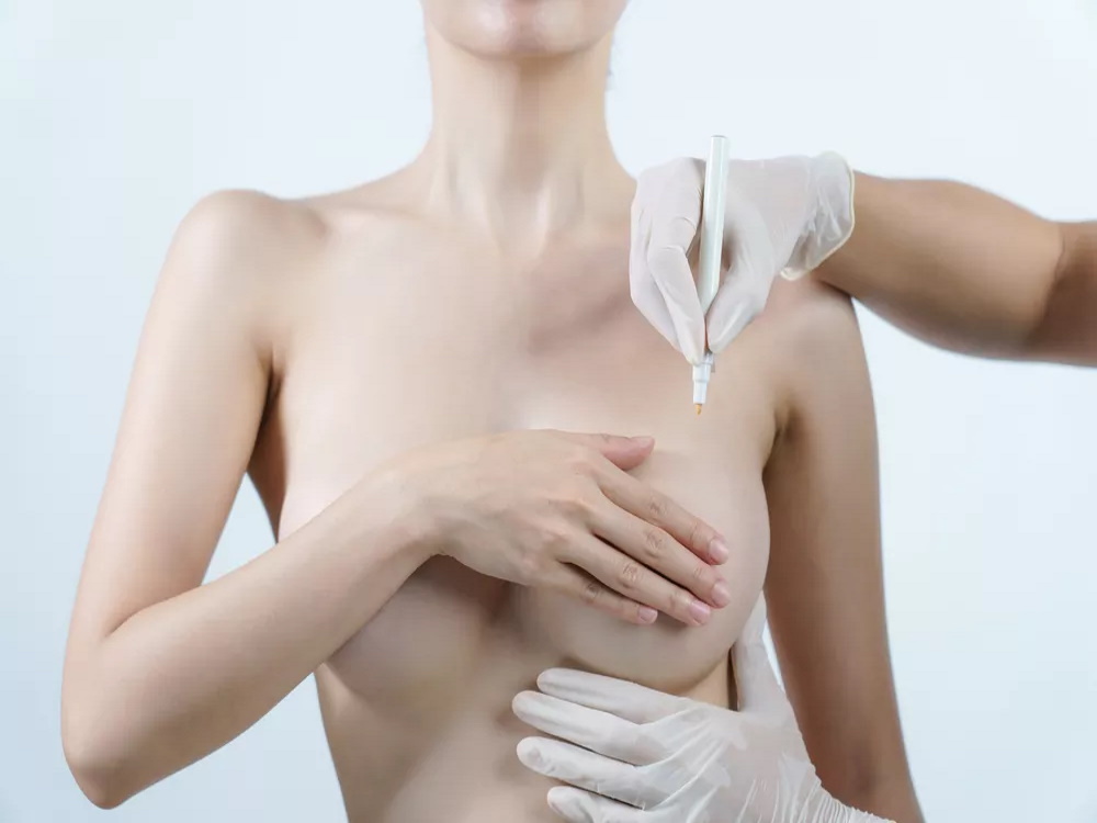 chirurgie esthétique de réduction mammaire
