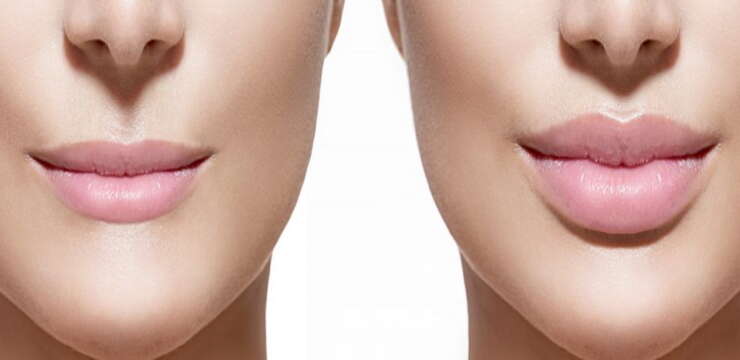 Lipofilling du visage