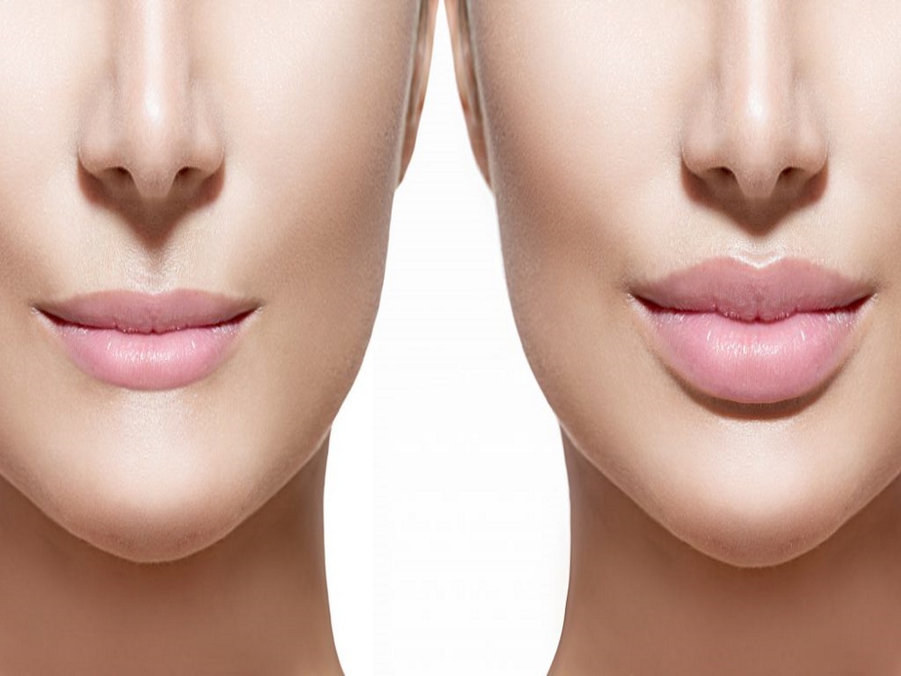 Lipofilling du visage