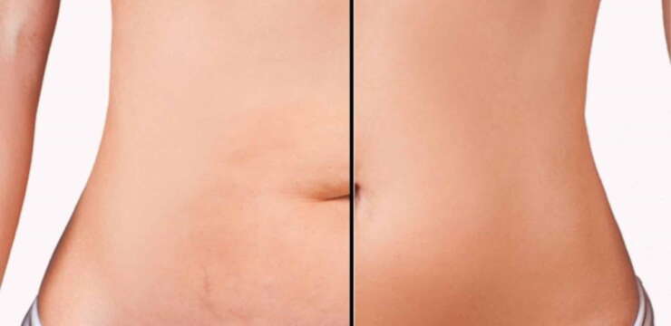 abdominoplastie