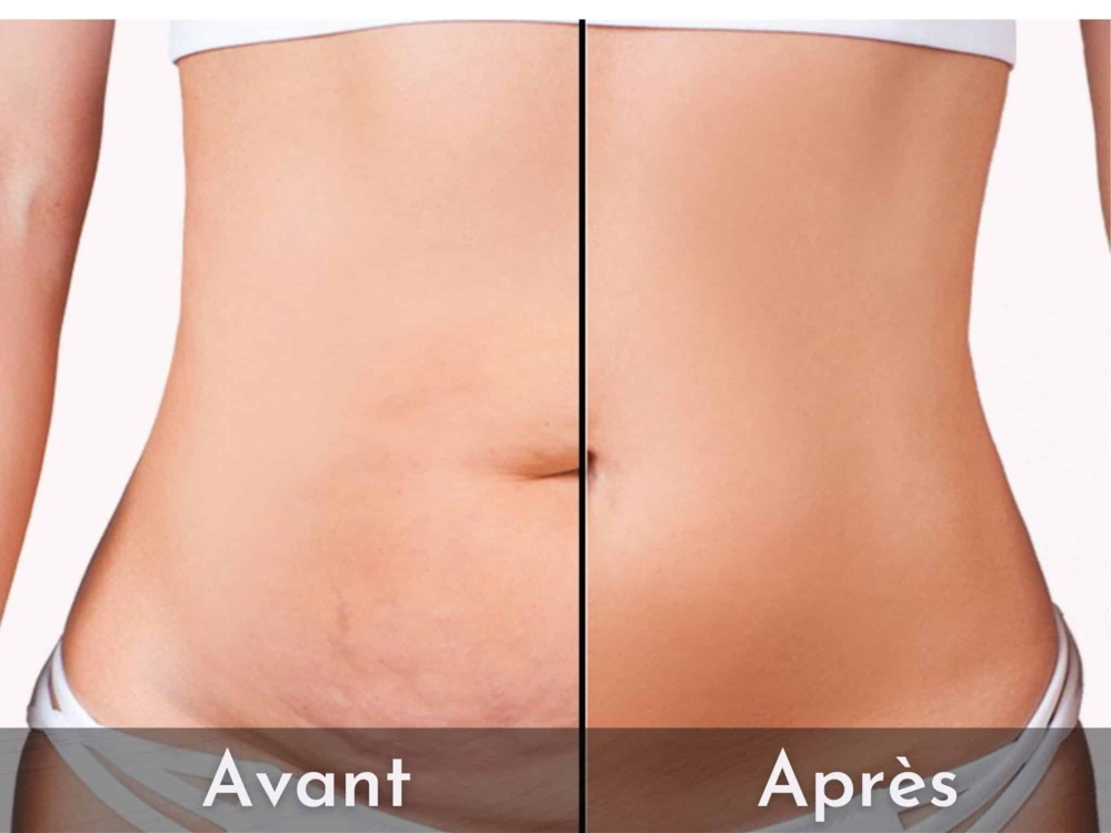 abdominoplastie