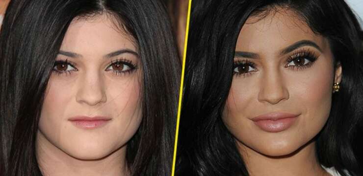 Kylie Jenner et la chirurgie esthétique