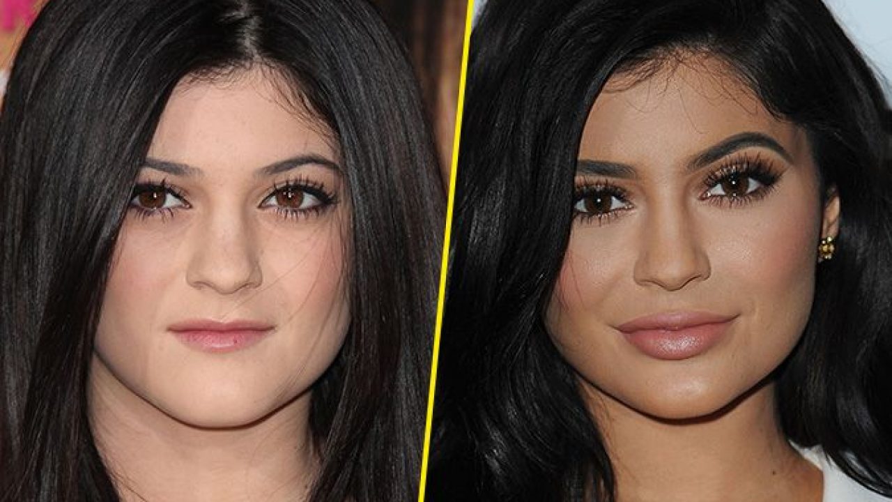 Kylie Jenner et la chirurgie esthétique