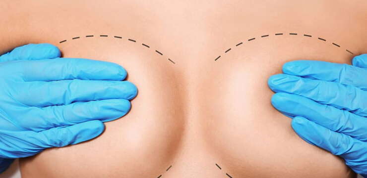 chirurgie mammaire