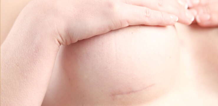 cicatrices augmentation mammaire