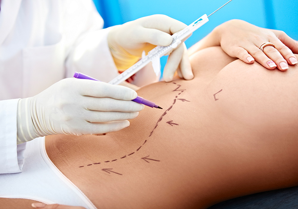 sutures en chirurgie esthétique