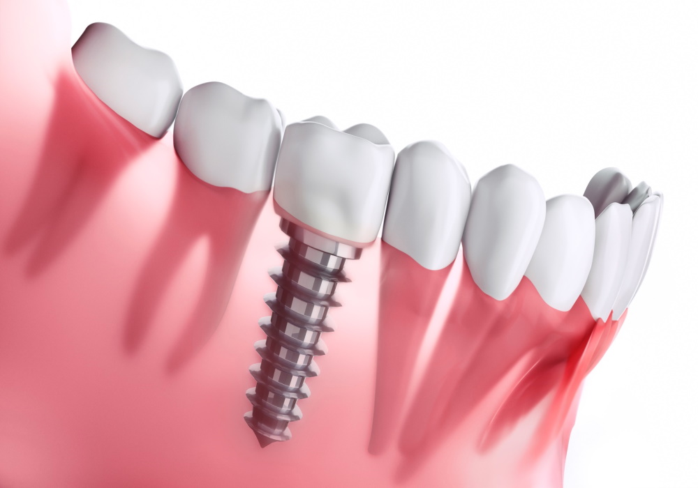 l'implant dentaire