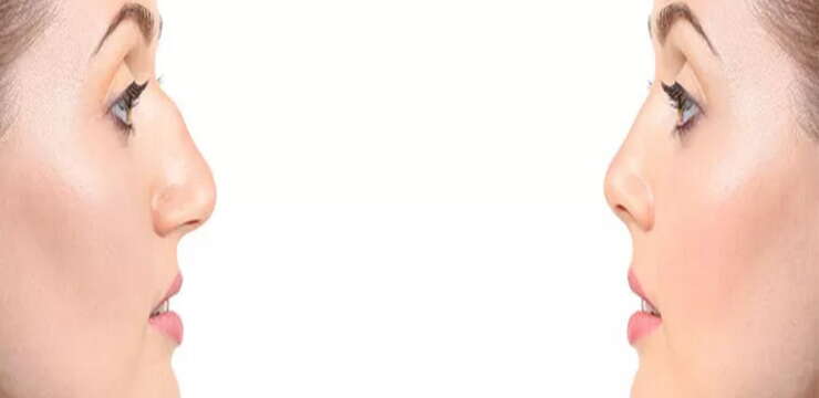 Rhinoplastie Tunisie