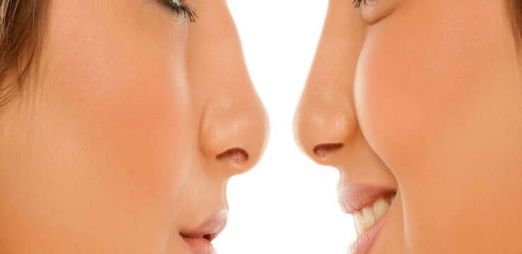 rhinoplastie en Tunisie