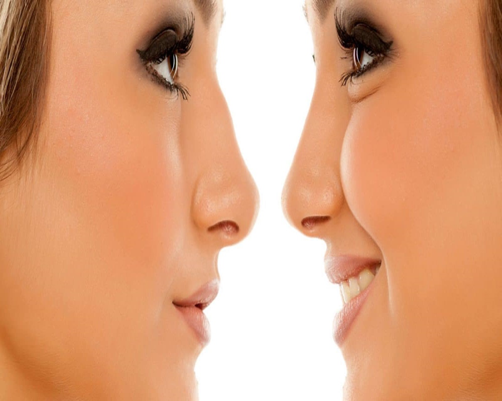 rhinoplastie en Tunisie