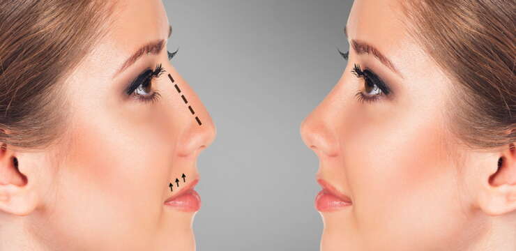 rhinoplastie