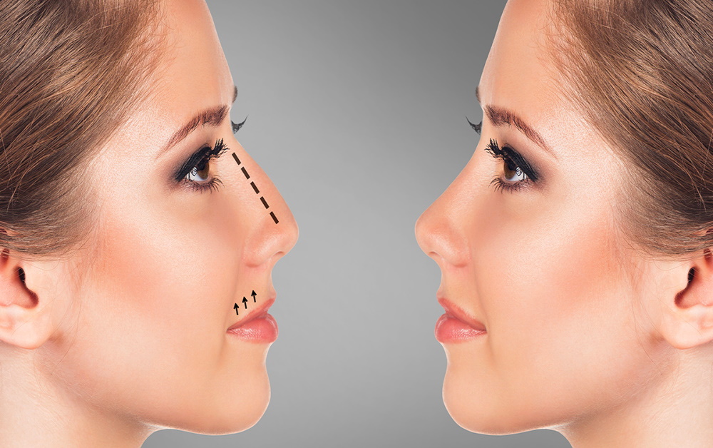 rhinoplastie