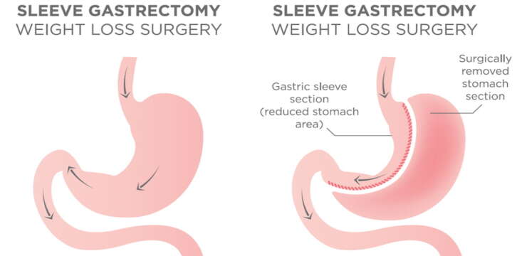 Sleeve gastrectomie