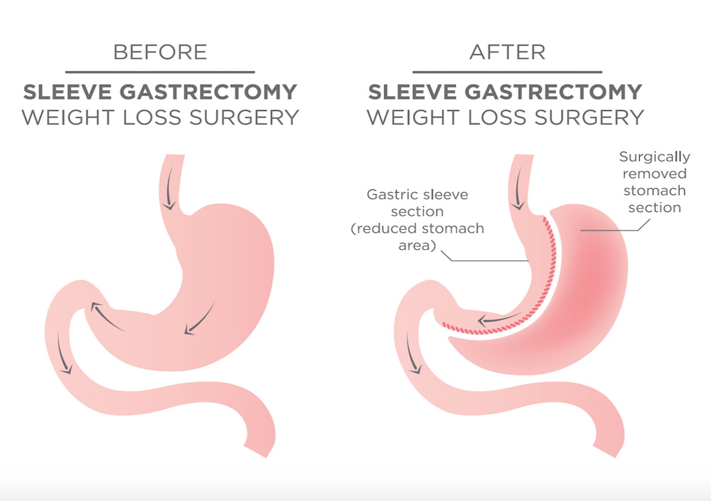 Sleeve gastrectomie