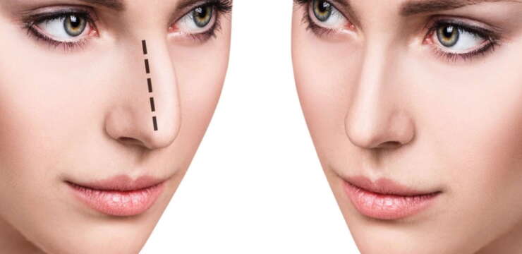 Rhinoplastie