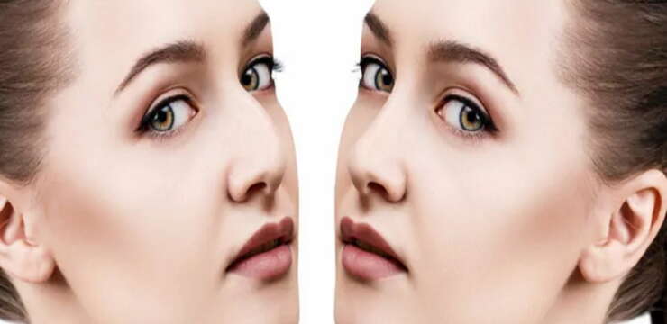 rhinoplastie