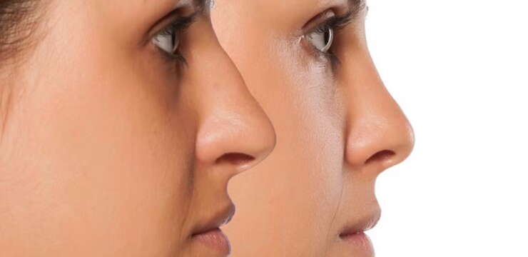 Rhinoplastie