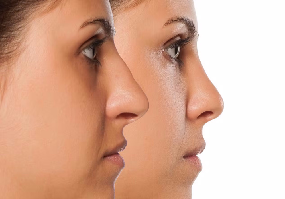 Rhinoplastie