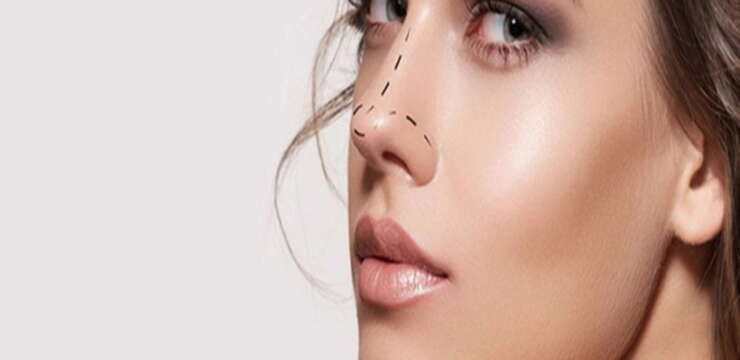 rhinoplastie