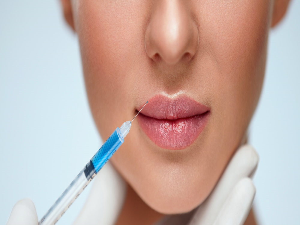 Injections des lèvres