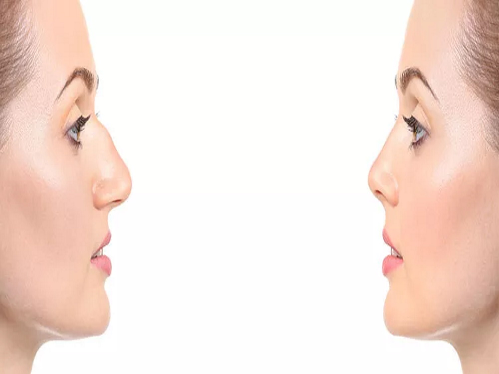 rhinoplastie