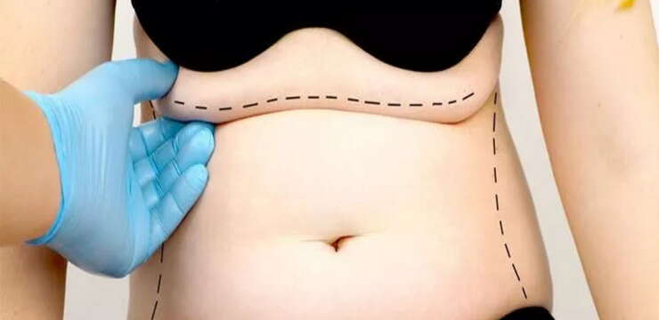 abdominoplastie