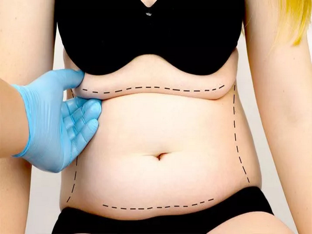 abdominoplastie