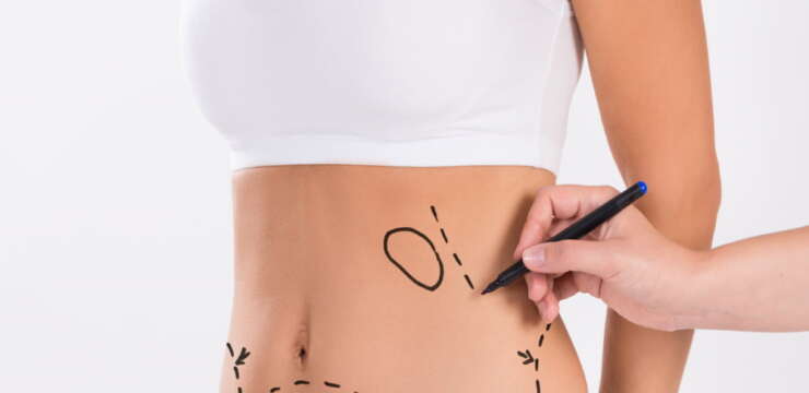 abdominoplastie