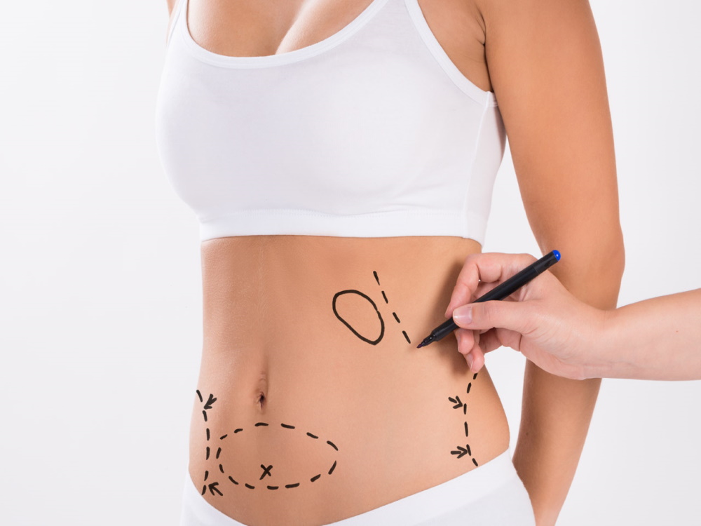 abdominoplastie