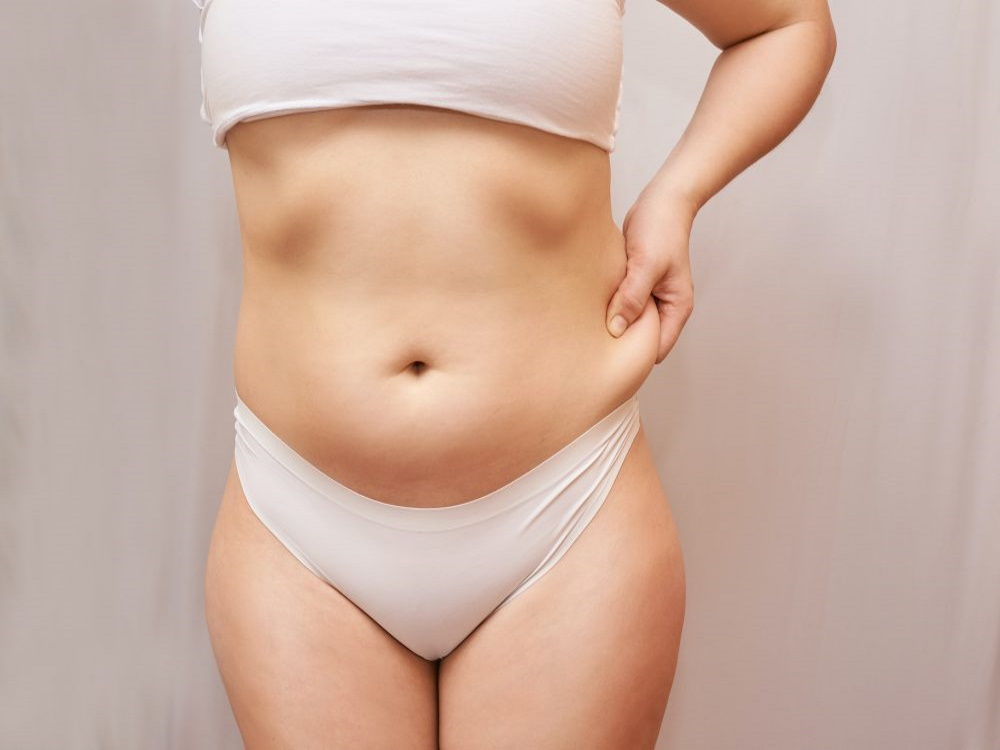 abdominoplastie