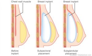 Lifting des seins en tunisie