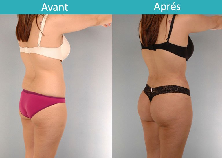 augmentation des fesses Tunisie