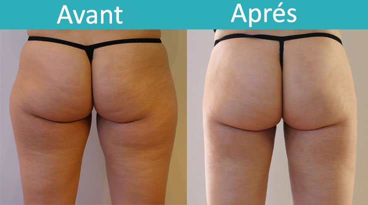 Liposuccion Tunisie Liposuccion Tunisie