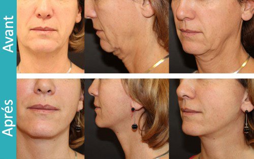 lifting cervico facial tunisie