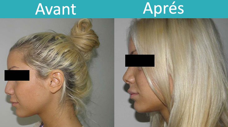 résultat d'une rhinoplastie tunisie