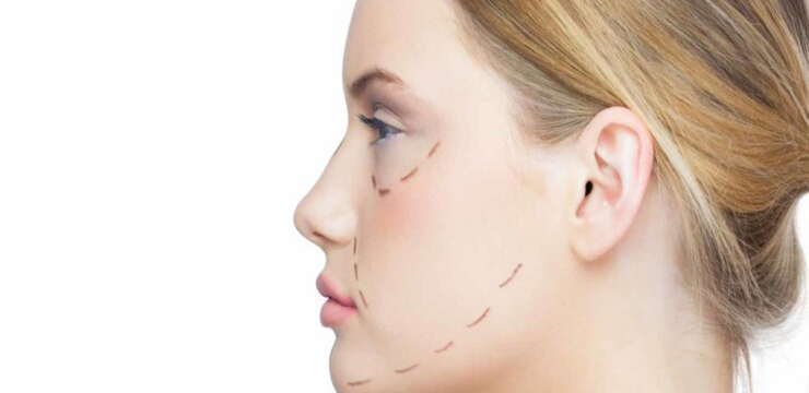 lifting cervico-facial