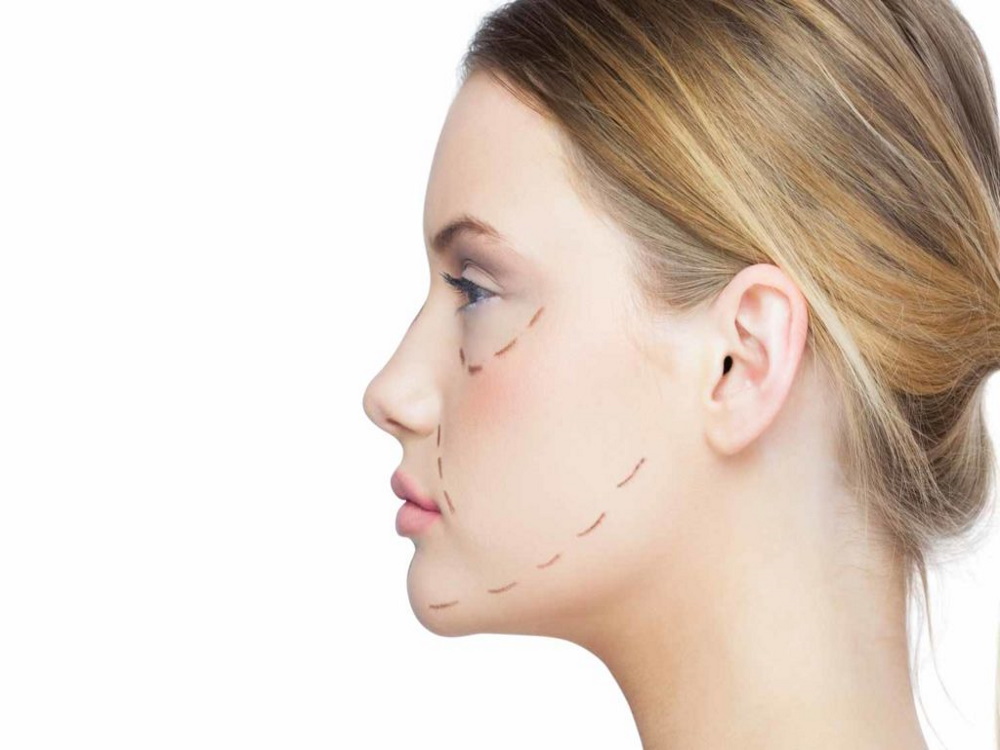 lifting cervico-facial