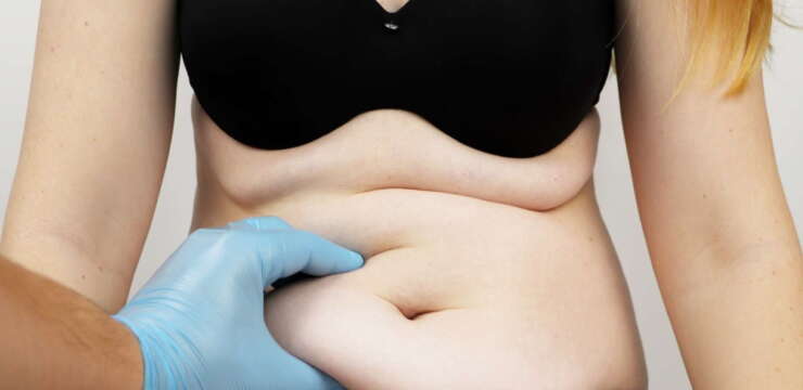 Abdominoplastie