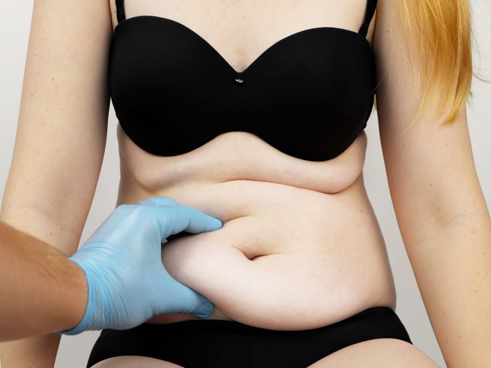 Abdominoplastie