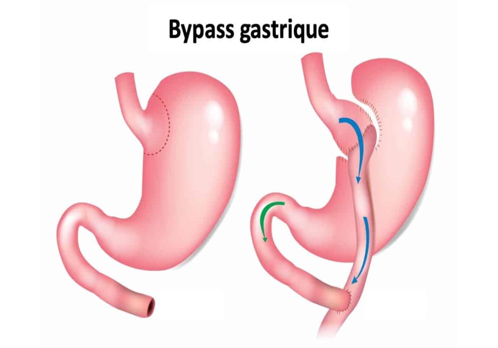 bypass gastrique