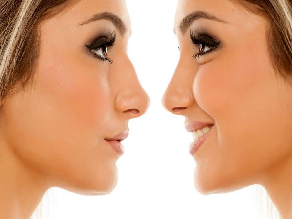 rhinoplastie