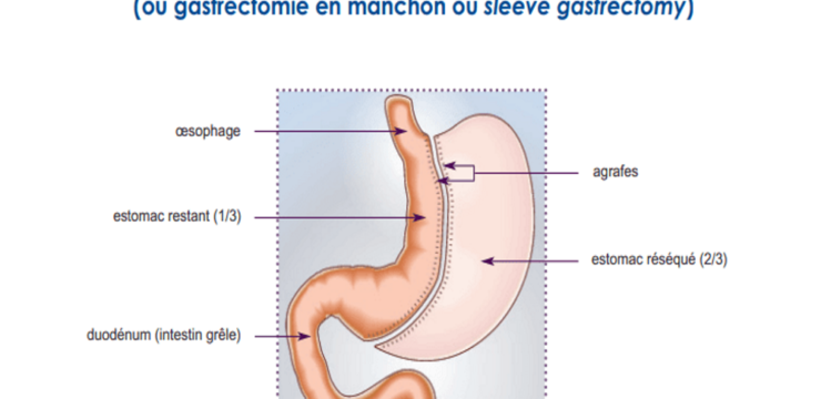 gastrectomie longitudinale