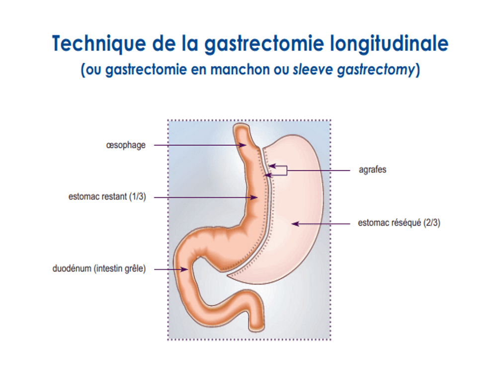 gastrectomie longitudinale