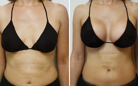 Le lipofilling des seins en Tunisie
